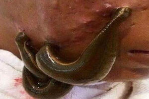 Rợn người với phương thức “đẹp lên nhờ đỉa” của chị em