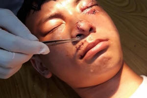 Nam định: Nam sinh lớp 10 bị nát mặt vì chó lạ tấn công