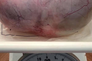 Bà già 67 tuổi mang khối u buồng trứng nặng 3,7kg