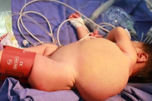 Phẫu thuật khối u bạch huyết khổng lồ cho bé trai 20 tháng tuổi