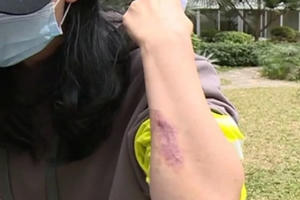 Bỏ gần 800 triệu nâng ngực, người phụ nữ bị hoại tử nặng