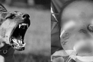 Trẻ 3 tuổi bị chó hàng xóm cắn nhiều vết trên mặt