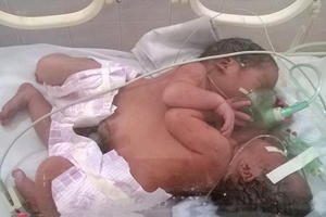 Bộ trưởng Tiến khen thưởng PGĐ BVĐK Vị Xuyên, đề nghị BV Việt Đức hỗ trợ tối đa cho cặp song sinh dính liền