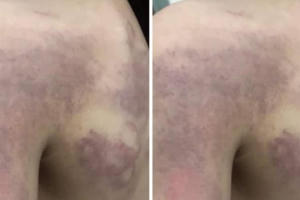 Đình chỉ cô giáo đánh học sinh lớp 3 bầm tím vì không hoàn thành bài tập