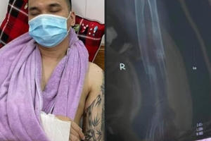 Ca sĩ Khắc Việt bị gãy tay phải nhập viện