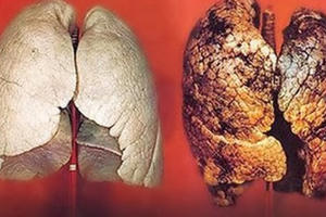 Bị ung thư phổi, phải làm gì để chiến thắng bệnh hiểm nghèo?