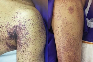 Ăn tiết canh giải đen cuối năm, 1 quý ông mất mạng