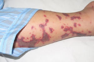 Ghi nhận ca mắc viêm não mô cầu đầu tiên tại Hà Nội Ghi nhận ca mắc viêm não mô cầu đầu tiên tại Hà Nội