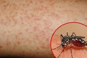 Tăng cường các biện pháp phòng chống dịch bệnh sốt xuất huyết Tăng cường các biện pháp phòng chống dịch bệnh sốt xuất huyết