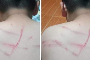 Thanh Hóa: Tạm đình chỉ cô giáo đánh bầm tím lưng học sinh