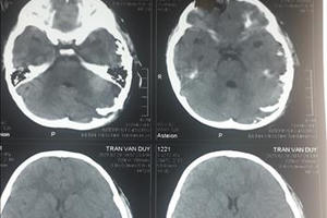 Phẫu thuật thành công cho bé 4 tuổi bị chó cắn hở sọ não