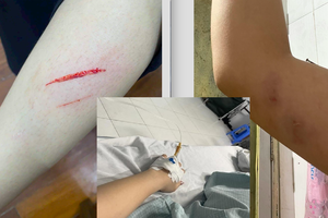 Công an vào cuộc vụ nữ sinh bị đánh thương tích khi làm thêm tại nhà hàng Hội Quán