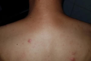 Bệnh phong cùi tái xuất ở Lạng Sơn