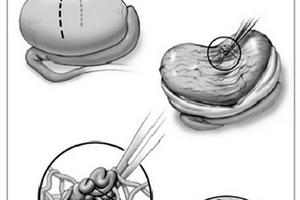 Kỹ thuật vi phẫu trích tinh trùng từ tinh hoàn: Cứu tinh cho các cặp vợ chồng hiếm muộn