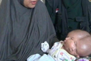 Em bé chào đời với hai gương mặt