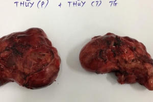 Choáng với hình ảnh hai khối u “siêu khổng lồ” được lấy ra từ cổ cụ bà 79 tuổi