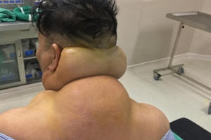 Người đàn ông dị dạng, nổi u khổng lồ do rượu