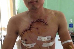 BV Việt Đức cứu sống bệnh nhân tai nạn giao thông lộ tim và phổi ra ngoài thành ngực BV Việt Đức cứu sống bệnh nhân tai nạn giao thông lộ tim và phổi ra ngoài thành ngực