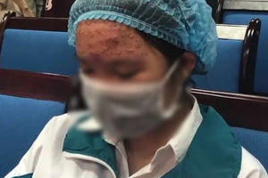 Thiếu nữ 15 tuổi chi chít mụn sau một lần bôi kem trộn