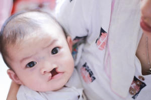 “Hồi sinh” nụ cười cho 100 trẻ mắc dị tật sứt môi, hở hàm ếch