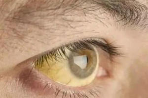 4 dấu hiệu trên khuôn mặt cảnh báo gan đang kêu cứu