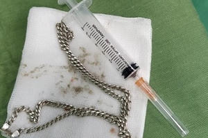 Chơi đùa một mình, bé 29 tháng tuổi nuốt cả sợi dây chuyền bạc vào sâu trong tá tràng