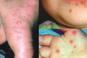 Các bệnh trẻ thường mắc phải khi vào hè Các bệnh trẻ thường mắc phải khi vào hè