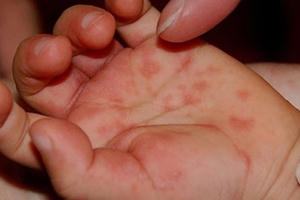 Lo ngại bùng phát dịch tay chân miệng, Bộ Y tế khuyến cáo phòng dịch