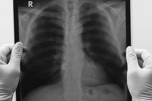 Vì sao không hút thuốc vẫn bị ung thư phổi?