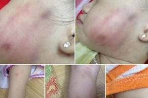 Trẻ bị bạo hành có thể bị động kinh, sang chấn tâm lý!