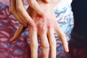 Thiếu Vitamin D ảnh hưởng nghiêm trọng đến sức khỏe như thế nào?