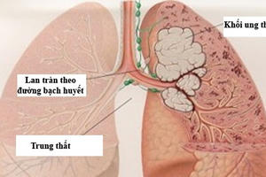 17.000 người tử vong mỗi năm do thuốc lá 17.000 người tử vong mỗi năm do thuốc lá