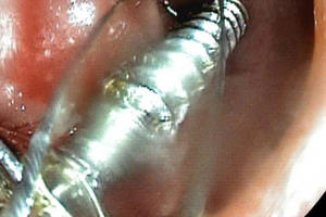 Đi học ở trường mầm non, bé 3 tuổi nghi nuốt phải đinh vít tử vong