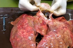 Hút thuốc lá dễ chết sớm hơn 20 năm