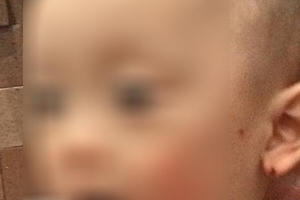 Bé trai 20 tháng bị cắn tím lưng: Hai vợ chồng hiệu trưởng trường mầm non đến tận nhà xin lỗi