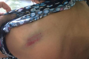 Quảng Ninh: Bà ngoại bị cháu đánh trọng thương gãy 5 chiếc xương sườn