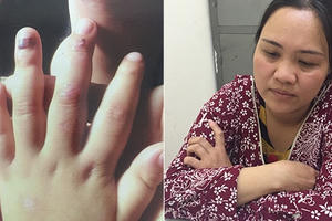 Lạng Sơn: Mẹ hờ bạo hành con của chồng, khắp cơ thể chi chít vết thương