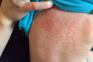 Bệnh viện Nhi Trung ương: 85% trẻ mắc bệnh sởi đều chưa được tiêm phòng Bệnh viện Nhi Trung ương: 85% trẻ mắc bệnh sởi đều chưa được tiêm phòng