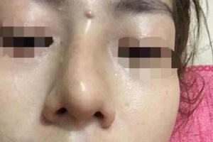 Tiêm filler nhiều quá mức sẽ gây biến chứng chèn mạch