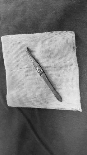 Quảng Ninh: Phẫu thuật lấy ra khỏi hàm bệnh nhi 01 cây nhíp bằng thép dài 10 cm xuyên từ miệng lên mũi