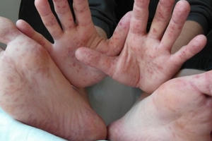 Cẩn trọng dịch tay chân miệng bùng phát