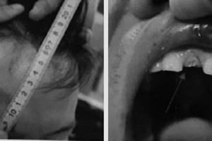 Vụ cố ý gây thương tích tại Hoành Bồ, Quảng Ninh: Lạ lùng việc giám định thương tích “4 không”