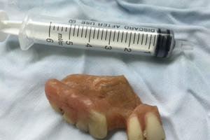 Nghệ An: Ăn bún, người đàn ông nuốt luôn hàm răng giả