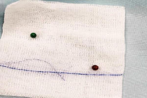 Bé trai 22 tháng tuổi bị 2 viên bi ghim chặt trong ruột hơn 6 tháng