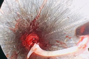 Hóc xương cá dài 4 cm, đến “bà mo” chữa nhiều ngày nhưng không khỏi