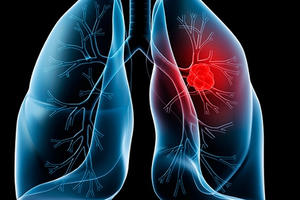 Phương pháp mới giúp phát hiện sớm ung thư phổi Phương pháp mới giúp phát hiện sớm ung thư phổi