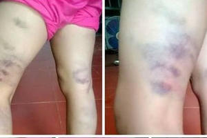 Học sinh lớp 2 bị cô giáo đánh tím hai chân chỉ vì viết sai một chữ