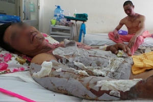 Trượt chân, một nông dân bị lửa rẫy thiêu sống