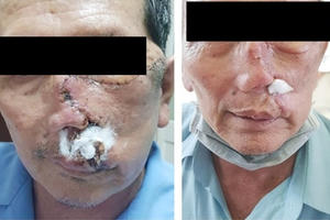 Biến chứng nặng hơn vì dùng thuốc nam tự chữa trị ung thư