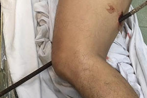 Ngã từ độ cao 5 mét xuống đất, nam thanh niên bị thanh sắt đâm xuyên đùi
